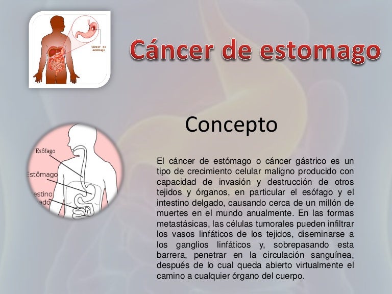 Cancer de estomago tratamiento quimioterapia